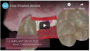 Pose d'implant dentaire